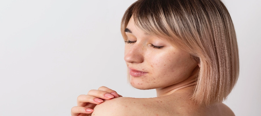 Imagem da notícia Hiperpigmentação: causas, sinais e tratamentos