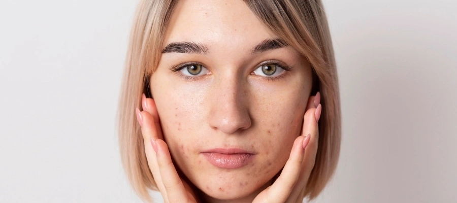 Imagem da notícia Gluconolactona melhora acne? Como usar no skincare?