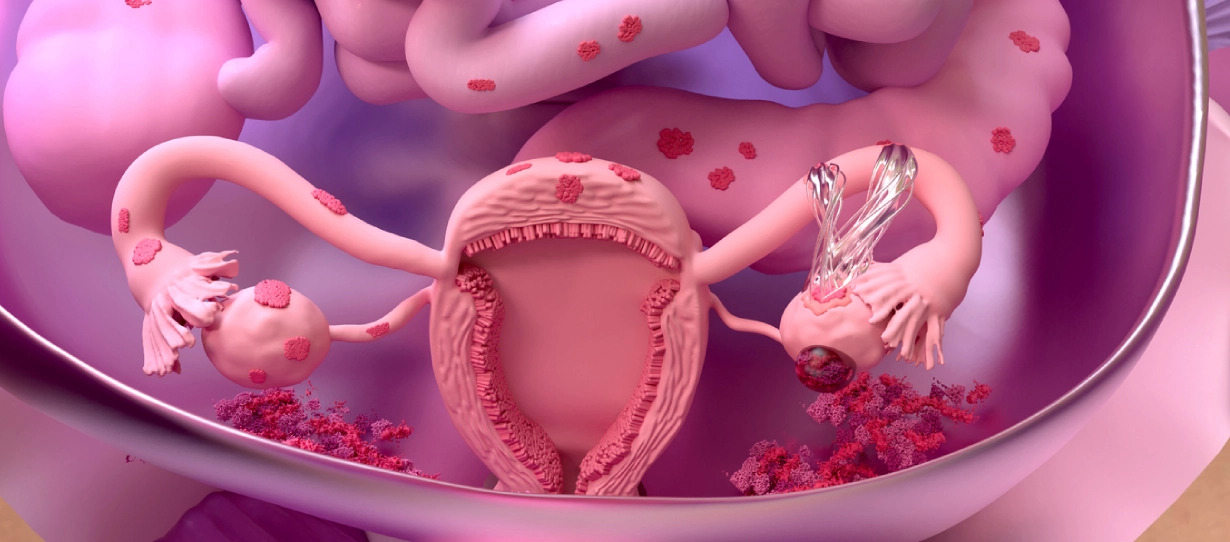 Anticoncepcional para endometriose: indicações e atualizações