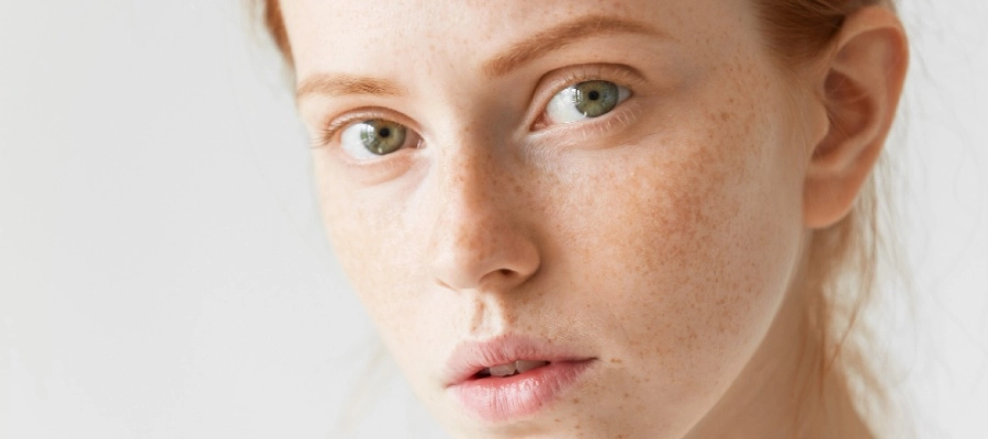 Imagem da notícia Como as manchas se formam: tipos, causas, tratamentos e muito mais!