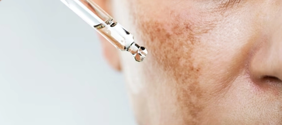 Imagem da notícia Clareador de pele: principais ativos e procedimentos