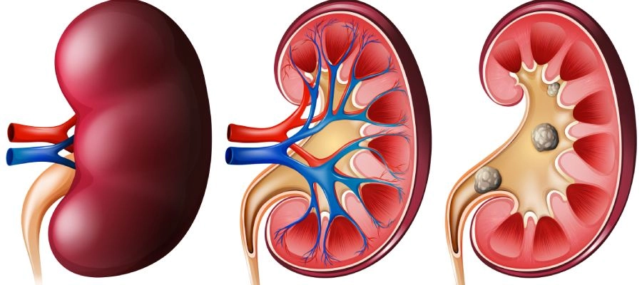 Imagem da notícia O que é cálculo renal e qual é o melhor tratamento?
